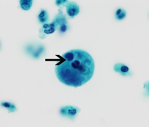 <p>Entamoeba gingivalis (commensal)</p>