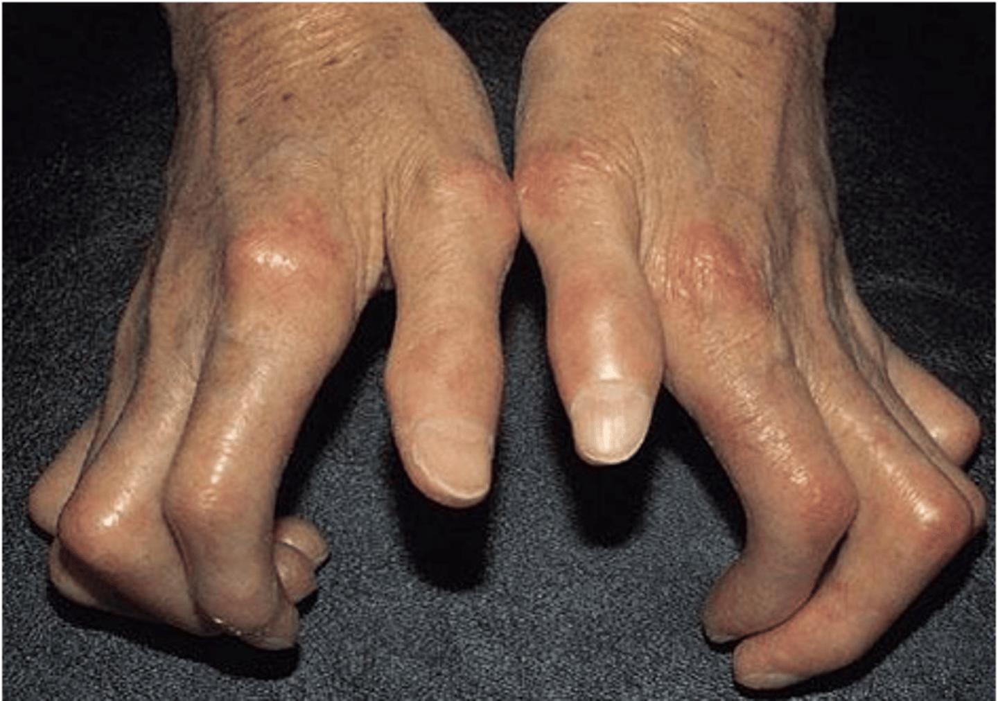 <p>-disease that involves the hardening and tightening of skin and connective tissues<br>-thickening and inflammation over joints is a classic sign<br>-symptoms vary depending on systems affected<br>-affects women &gt; men<br>-age of onset 30-50<br>-no cure</p>