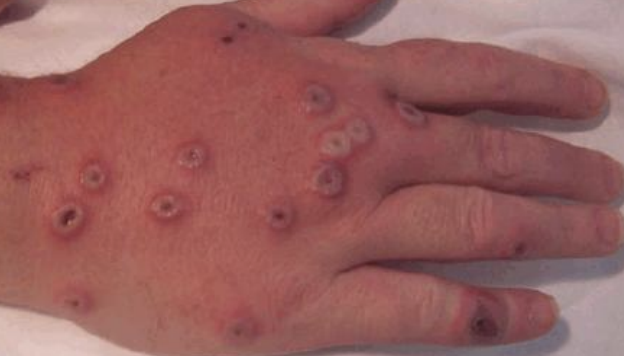 <p>Which older oral rabies vaccine was a living vaccinia virus with a rabies glycoprotein gene inserted? It was used in fishmeal and is not used anymore as it is pathogenic to immunocompromised people who come into contact with it in the wild.</p>