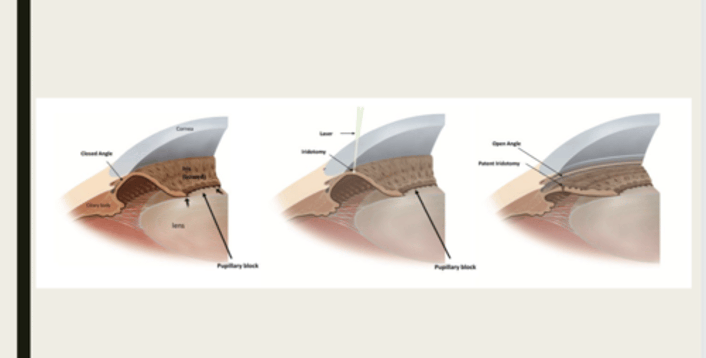 <p>What is the treatment for acute angle closure crisis?</p>