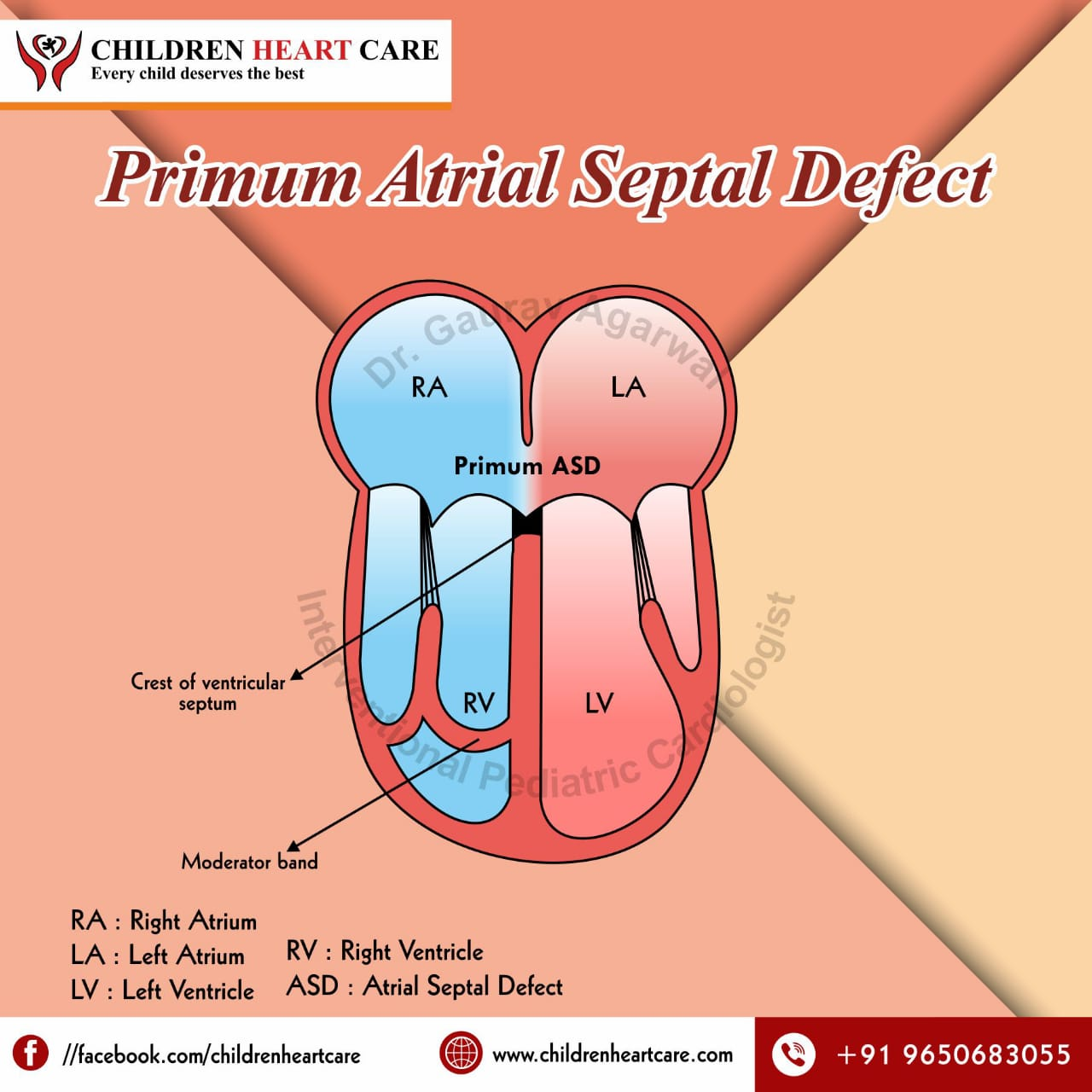 <p>ASD that occurs near the bottom part of the septum, close to valves</p>