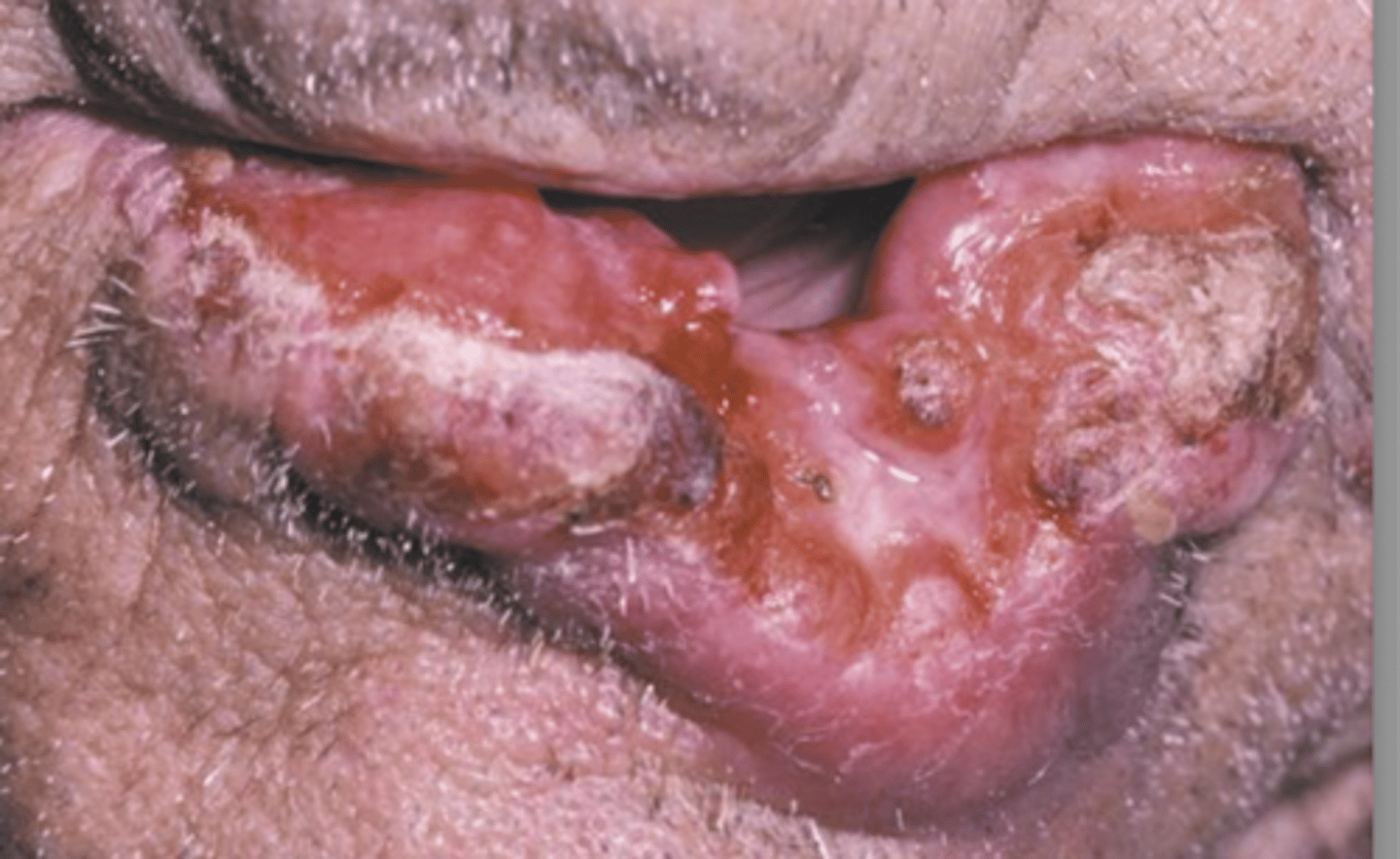 <p>Asymptomatic</p><p>Crusted</p><p>Oozing</p><p>Indurated</p><p>Slow growing "problem" for 12-16 months</p>