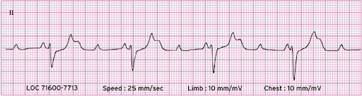 Rate: atrial 60 – 100; ventricular – varies 

Regularity: regular, irregular, or regular but interrupted

P waves: upright, matching, some blocked

PR: constant on the conducted beats

QRS: < 0.12 secs if no bundle branch block, > = 0.12 secs if bundle branch block