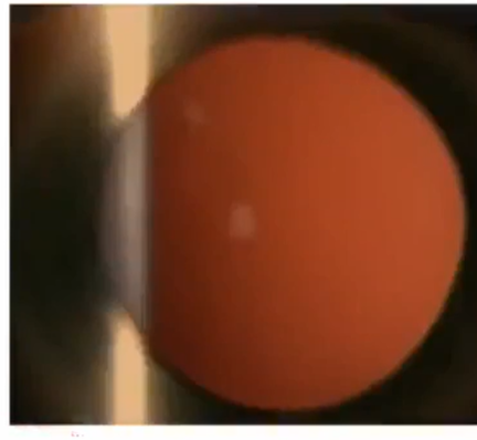 <ol><li><p><strong><u>monocular </u></strong></p></li><li><p>PPD</p></li><li><p><strong><u>focus on tissue to be examined - know where you are focused first </u></strong></p></li><li><p><strong><u>reduce beam angle to see red glow </u></strong></p></li><li><p><strong><u>cornea, lens, iris </u></strong></p></li></ol><p></p>