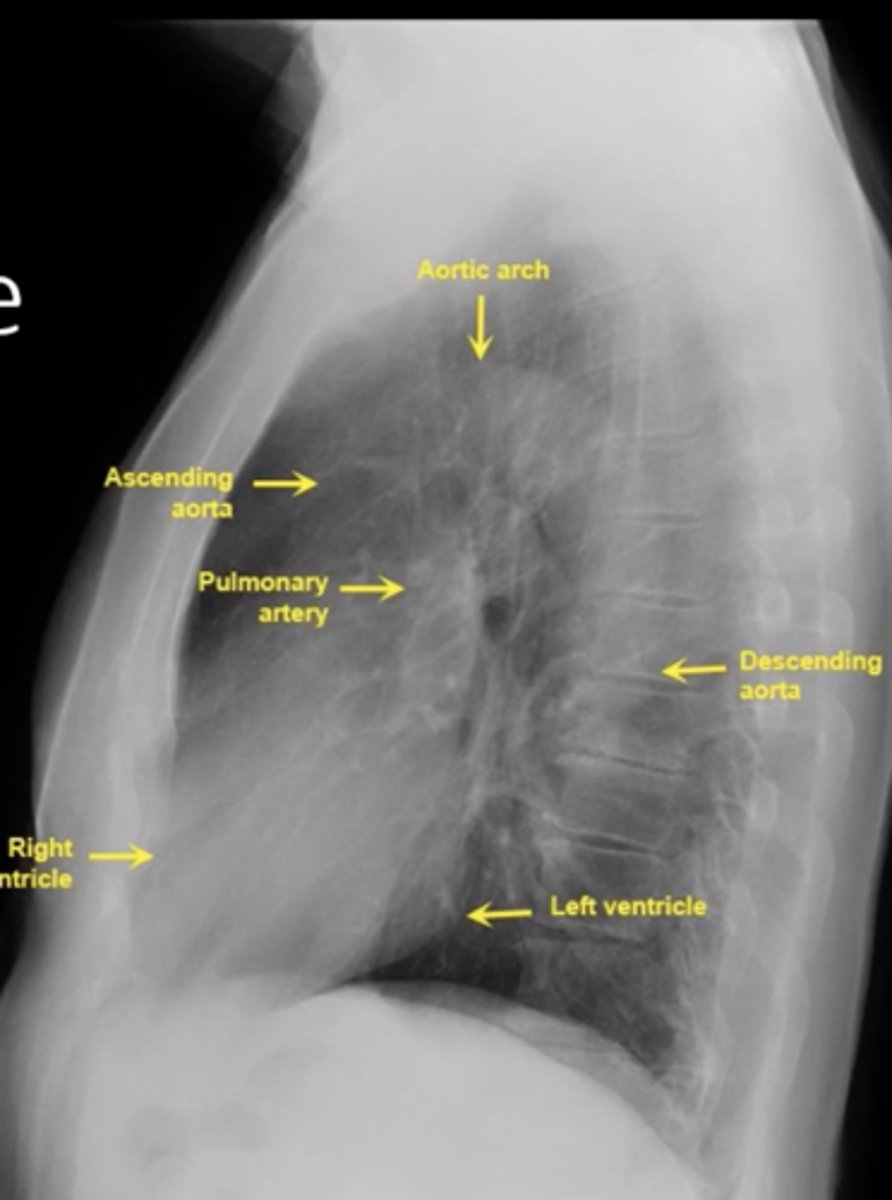 <p>lateral cardiac silhouette</p>