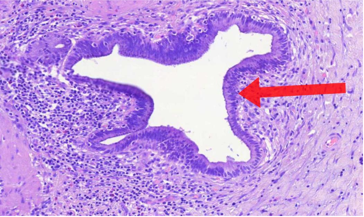<p>kohonneen paineen vuoksi seinämä on paikoin työntynyt lihaskerroksen lomaan syviksi poimuiksi, näitä kutsutaan <<strong><u>mikä nimi</u></strong>>, sen ympärillä havaitaan myös tulehdussolulisää (vinkki: krooninen kolekystiitti)</p>