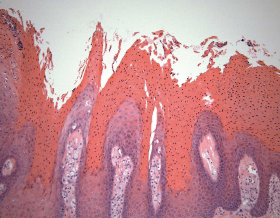 <ol><li><p>papillary, acanthotic surface covered by parakeratin</p></li><li><p>large macrophages w/ foamy cytoplasm&nbsp;</p></li></ol><p></p>