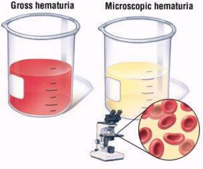 <ul><li><p>More than two to three blood cells per high-powered field are seen</p></li><li><p>The presence of red blood cells in the urine</p><ul><li><p>Can be microscopic or macroscopic</p></li></ul></li><li><p>The underlying cause can be located in the kidneys, ureters, bladder or urethra</p><ul><li><p>Kidneys, urethra, and bladder can be visualized by US</p></li></ul></li></ul><p></p>