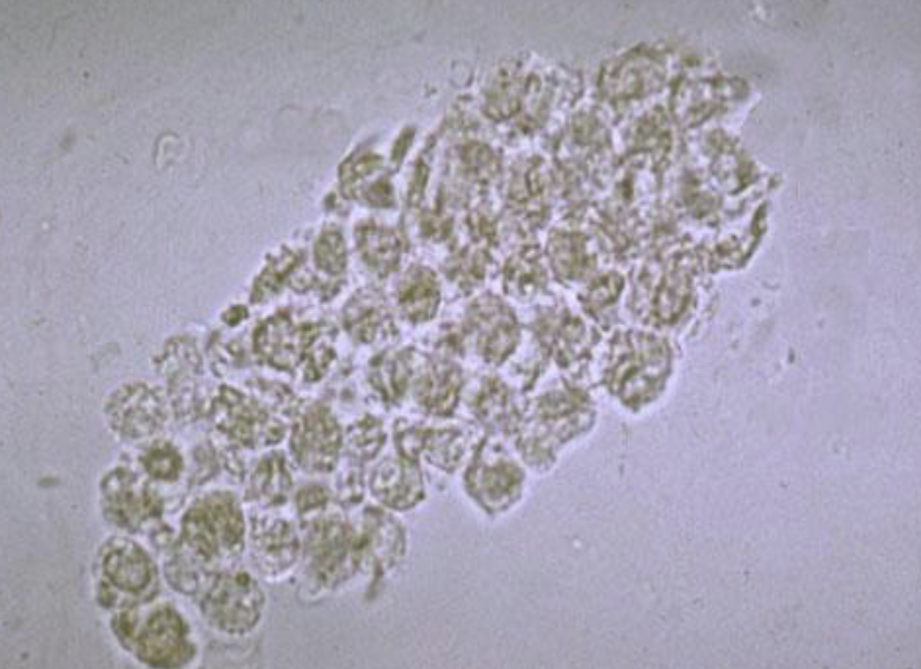 <p>What is this cast?</p><p>When is it seen?</p>