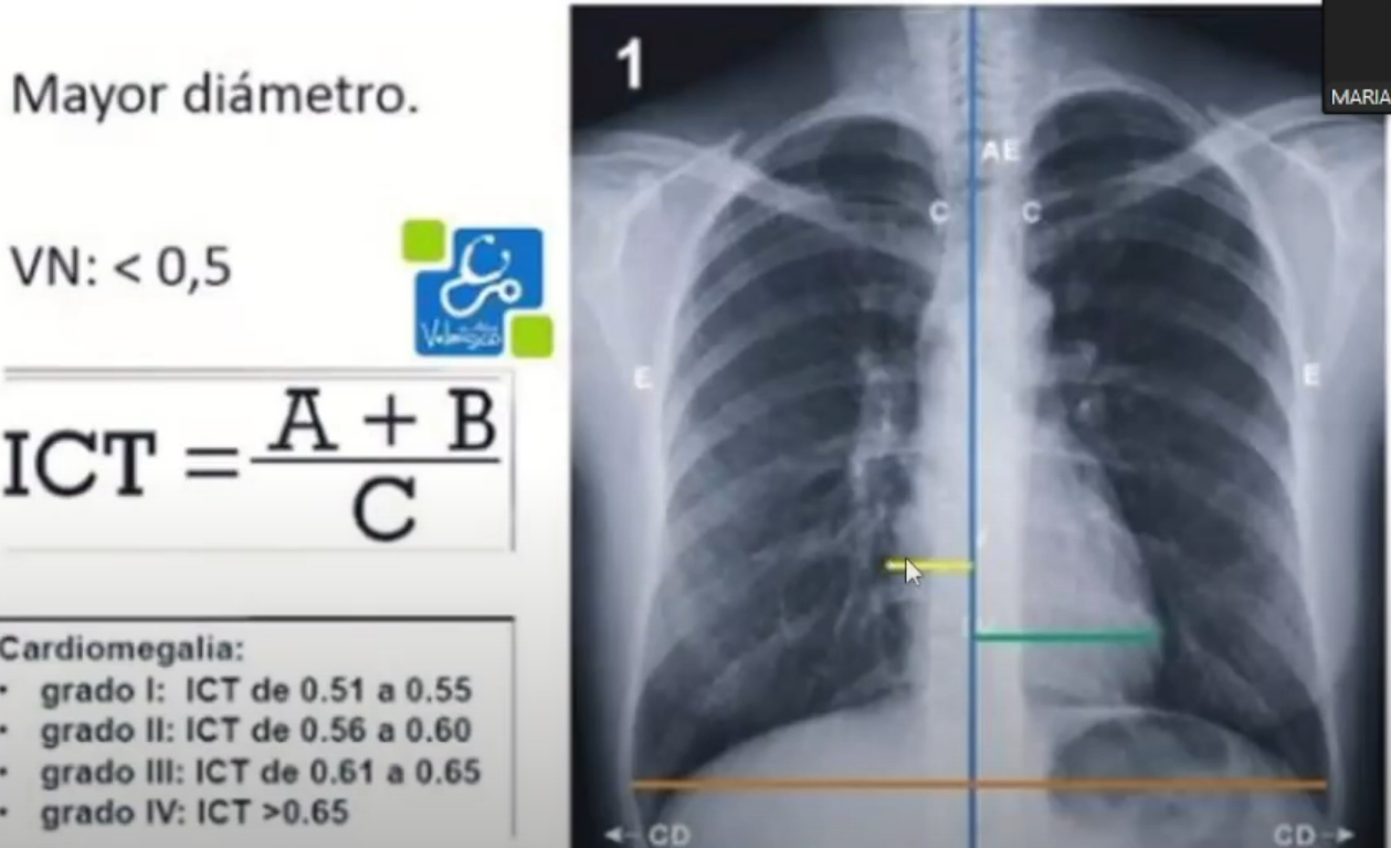 <ul><li><p>Se sospecha en una rx midiendo el <strong>índice cardiotorácico</strong></p></li><li><p>Se traza una <strong>linea media en las apófisis espinosas</strong></p></li><li><p>Se mide una <strong>distancia hasta el borde derecho y al borde izquierdo</strong></p></li><li><p>Estas <span style="color: red"><strong>2 medidas se suman y se dividen entre la distancia de la pared costal derecha a la pared costal izquierda y se multiplica por 100 = Índice cardiaco</strong></span></p></li><li><p>Normal: <span style="color: red"><strong>&lt;0.50, recién nacidos: &lt;0.6</strong></span></p></li><li><p><strong>Grado 1: 0.51-0.52</strong></p></li><li><p><strong>Grado 2: 0.53 - 0.59</strong></p></li><li><p><strong>Grado 3: 0-60 - 0-65</strong></p></li><li><p><span style="color: red"><strong>Grado 4: &lt;0.56 = Cardiomegalia severa</strong></span></p></li></ul><p></p>