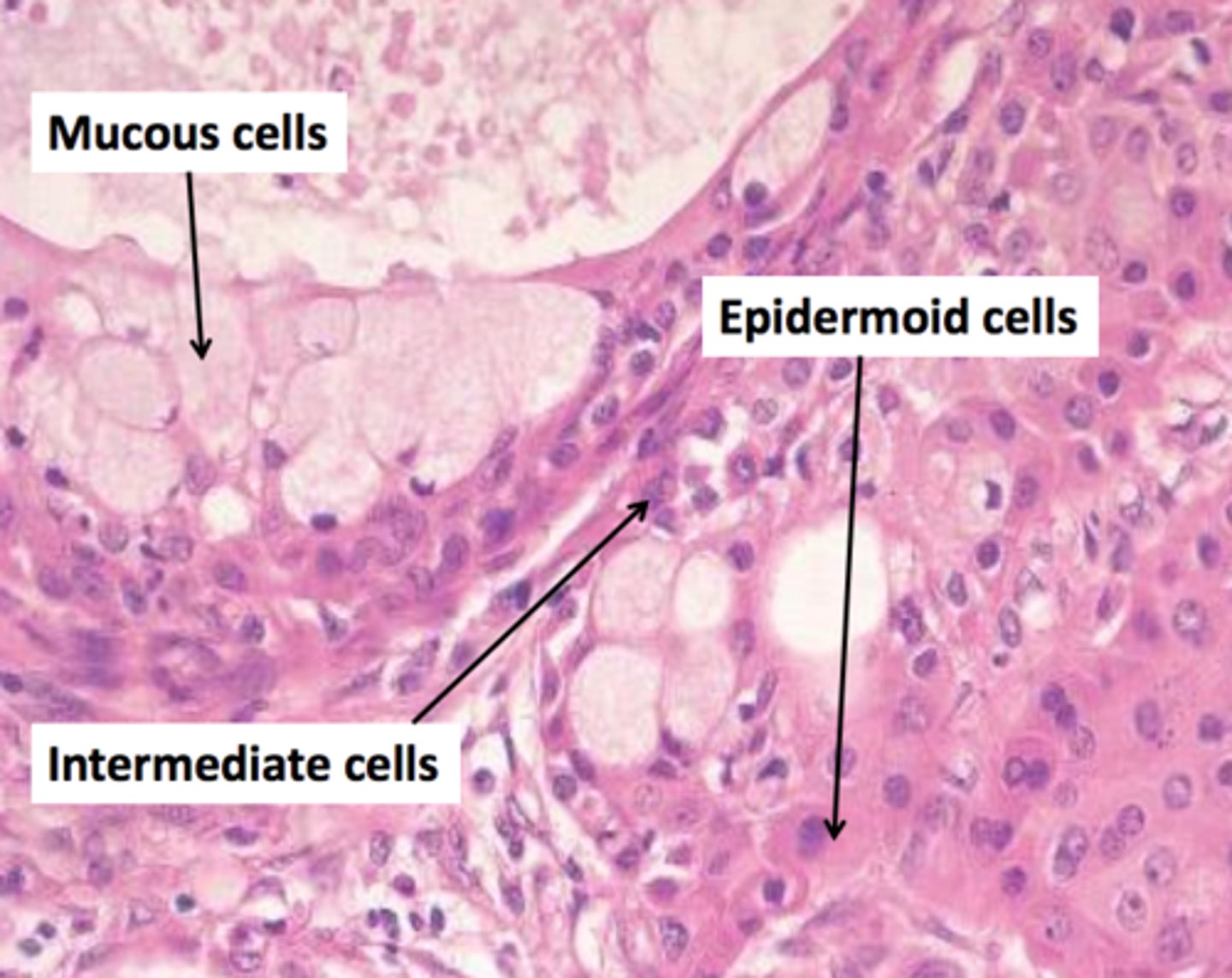 <p>Higher-grade tumours grow faster, invade earlier, and have a greater risk of metastasis.</p>