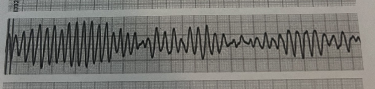 <p>Torsades De Pointes→ Polymorphic Vtach </p>