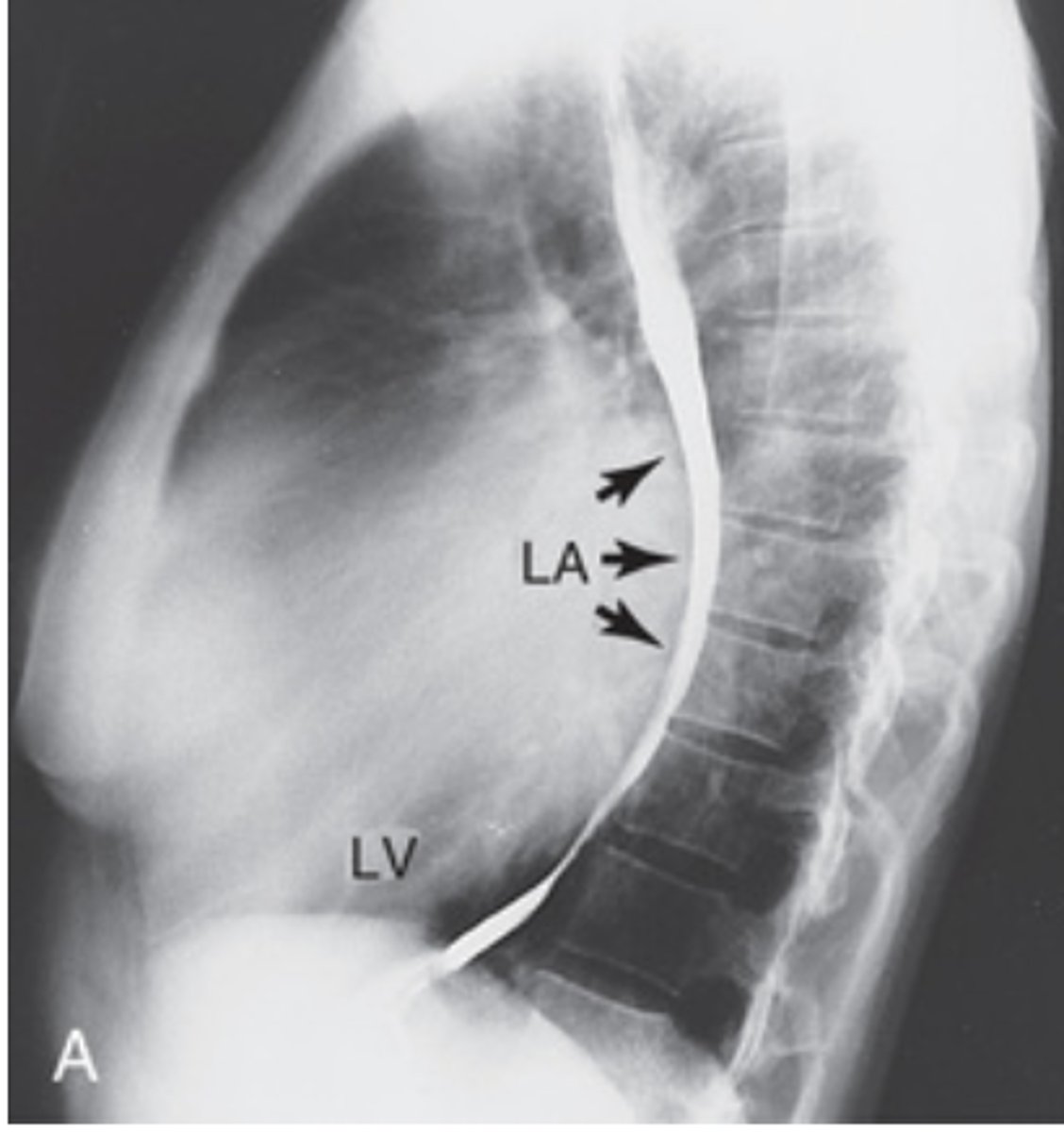 <p>Displaced esophagus</p>