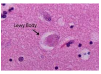 <p>corpos de lewy</p>