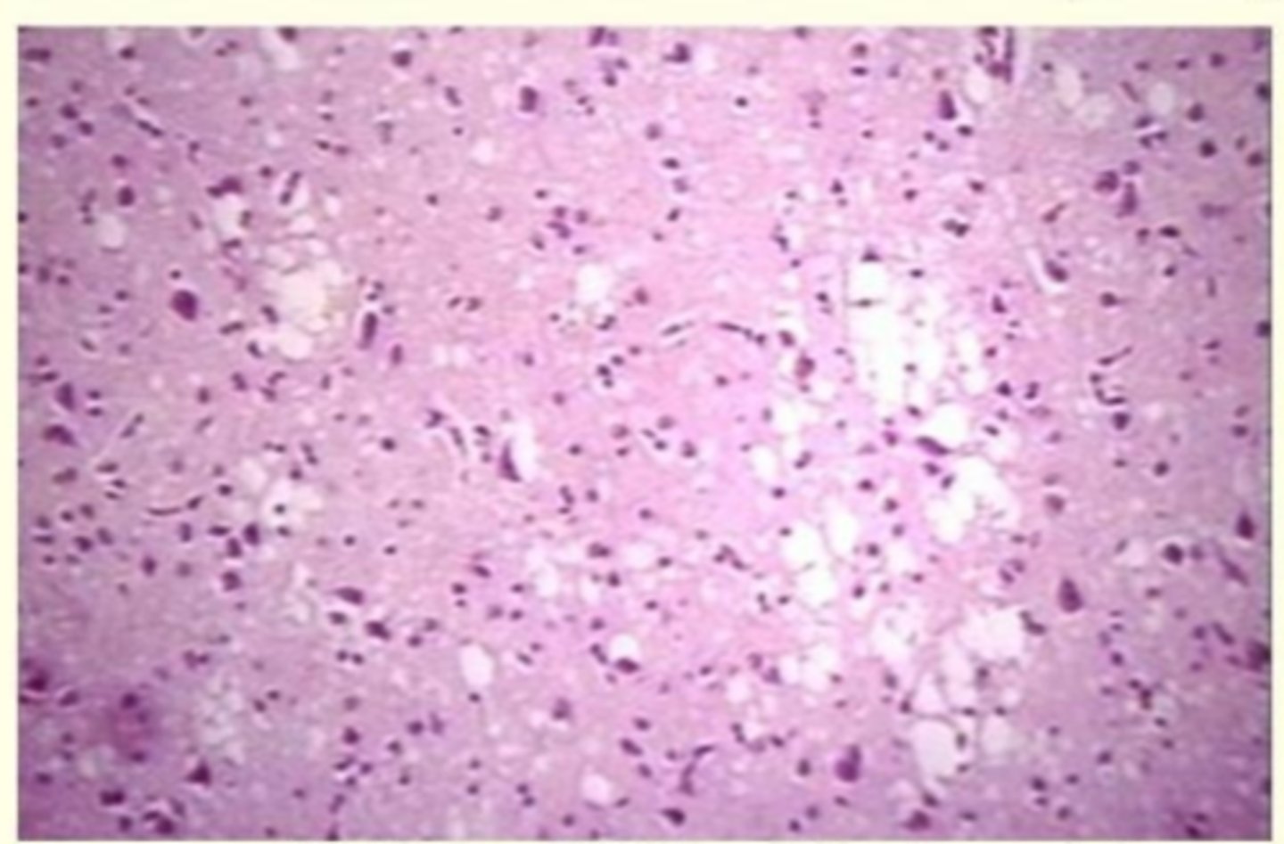 <p>cerebral cortex with coarse and fine vacuolations (spongiosis)</p>