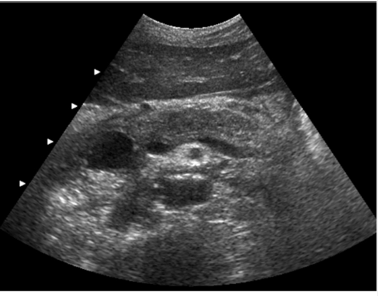 <p>This image was obtained in a 48-year-old male referred for an abdominal ultrasound because of abnormal liver function tests. Which of the following best describes the findings?</p><p>a. ectopic location of gallbladder</p><p>b. pancreatic head carcinoma</p><p>c. pancreatic head pseudocyst</p><p>d. fluid in the duodenum</p><p>e. peripancreatic lymphadenopathy</p>