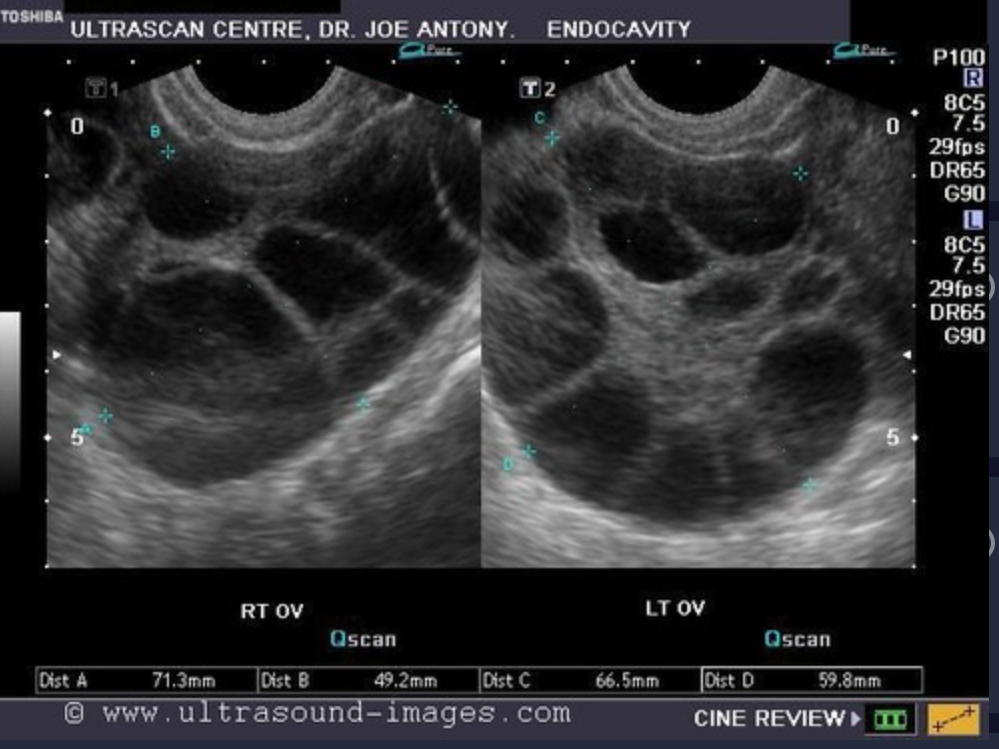 <p>What is a frequent iatrogenic complication of ovulation induction?</p>