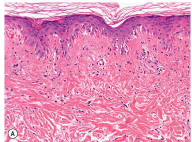 Acute
cutaneous LE showing mild
interface dermatitis with
vacuolization of basal keratinocytes
and sparse superficial lymphoid
infiltrates.