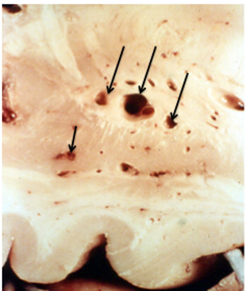 <p>Define Lacunar infarct/Slit Hemorrhages</p>