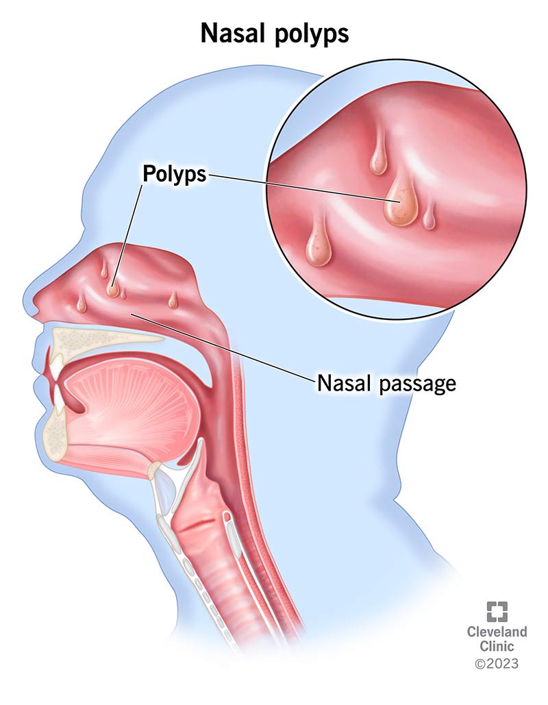 <p>Chronic rhinitis may cause sufficient irritation to cause polyp formation. They are swollen mucosal tissue that form due to <strong>chronic rhinitis irritation.</strong></p>