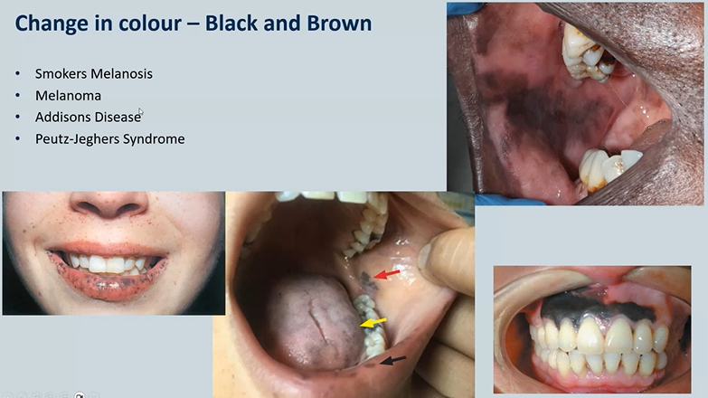 <ol><li><p>Smokers Melanosis - top right - seen in POC - physiological </p></li><li><p>Melanoma- skin cancer - rare bottom right</p></li><li><p>Addisons Disease - adrenal insufficiency </p></li><li><p>Peutz-Jeghers Syndrome - dotted - need to be seen by a GI doctor as theu may experience intestinal polyps </p></li></ol><p></p>