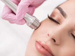 <p>Microdermabrasion </p>