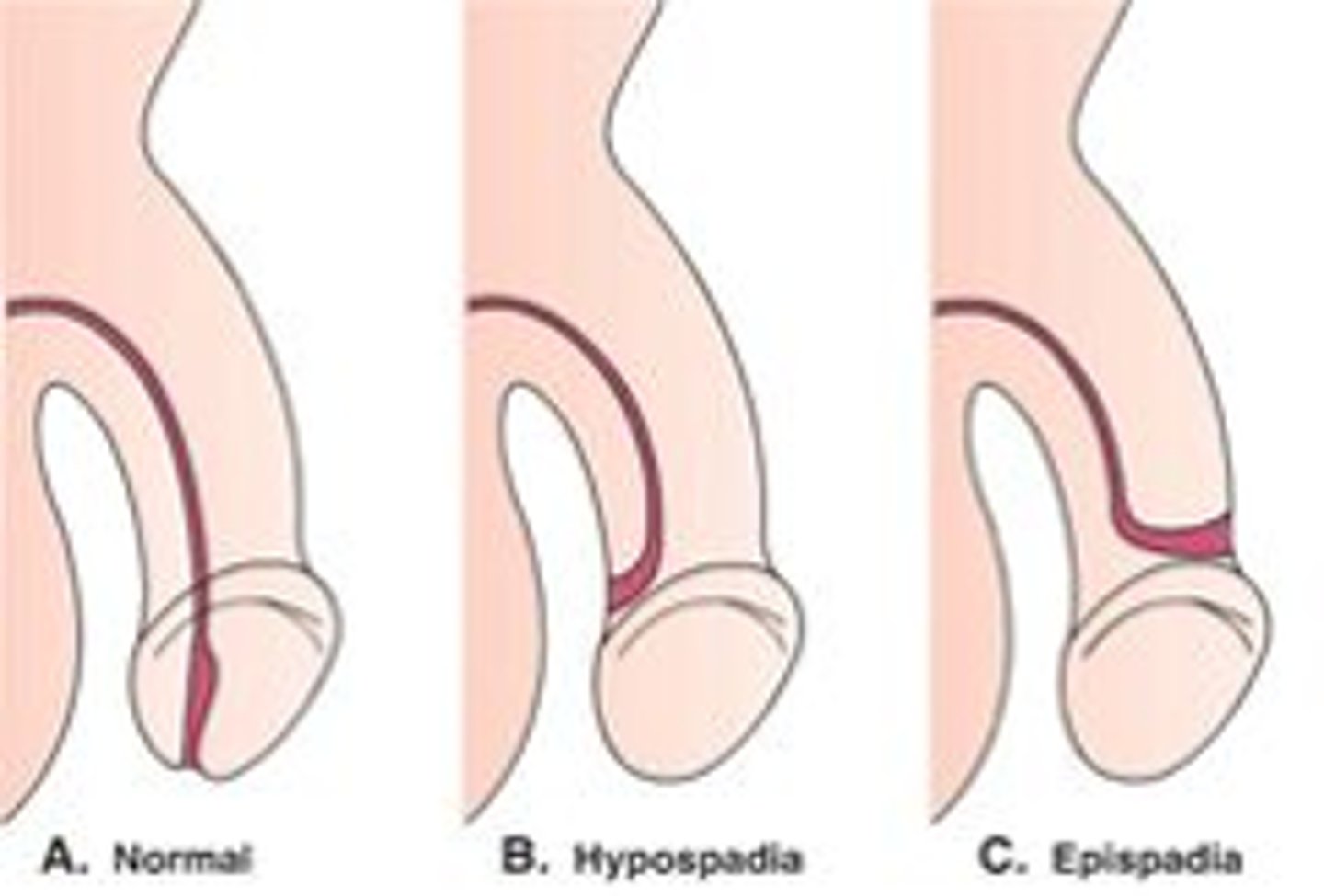 <p>Distal urethral orifice is present on the dorsal aspect of the penis</p><p>- Occurs when the genital tubercle fails to close</p><p>- Is associated with bladder exstrophy</p>
