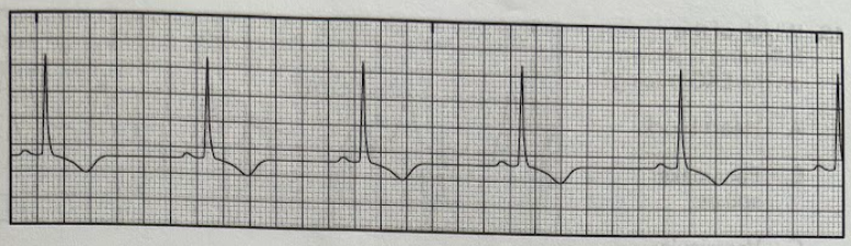 <p>Using the EKG tracing, identify which of the following wave forms is inverted for Lead II</p><p>A. P wave</p><p>B. Q wave</p><p>C. R wave</p><p>D. T wave</p>