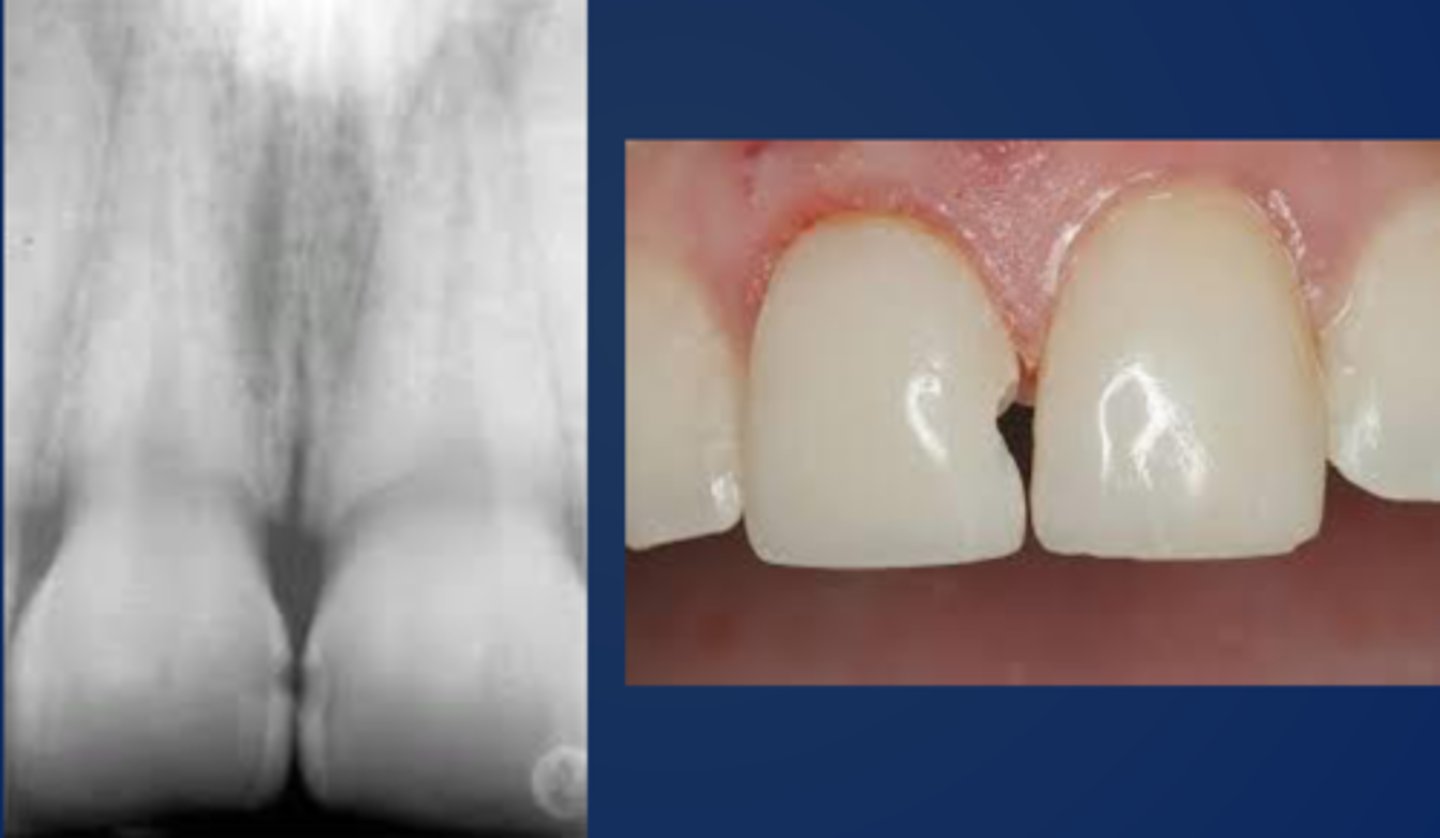 <p>- walls may diverge externally from axial wall</p><p>- beveled margin design</p><p>- ultraconservative internal prep</p><p>- no wall from entrance = lingual wall blends with gingival/incisal walls</p>