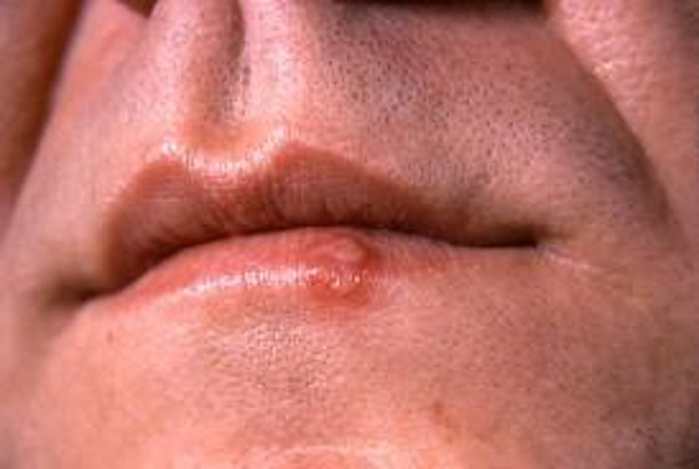 <p>Causes cold sores and fever blisters,</p><p>Can also be found in facial and vestibular cranial nerves</p><p>(HSV-2 is found in spinal nerves serving genital area (causes genital herpes)</p>