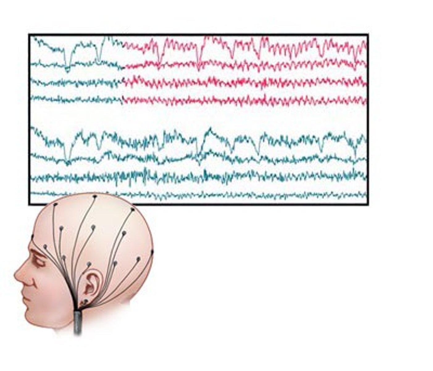 <p>An amplified recording of the waves of electrical activity that sweep across the brain's surface. These waves are measured by electrodes placed on the scalp.</p>