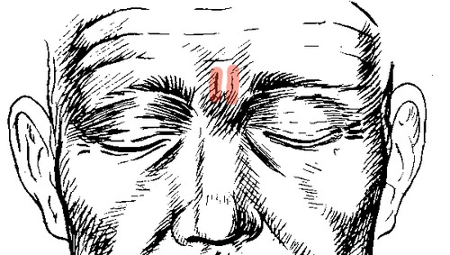 <p>wrinkles between eyebrows; acquired</p>