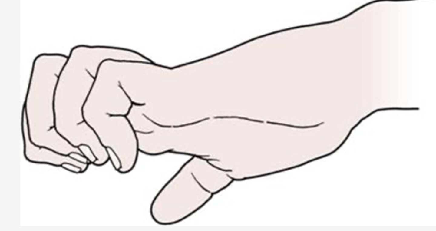 <p>intrinsic minus hand, caused by combination of median & ulnar nerve</p><p>results from the loss of intrinsic muscle action and the overaction of the extrinsic extensor muscles on the proximal phalanx of the fingers</p><p>MCP joints are hyperextended, and PIP and DIP joints are flexed.</p>