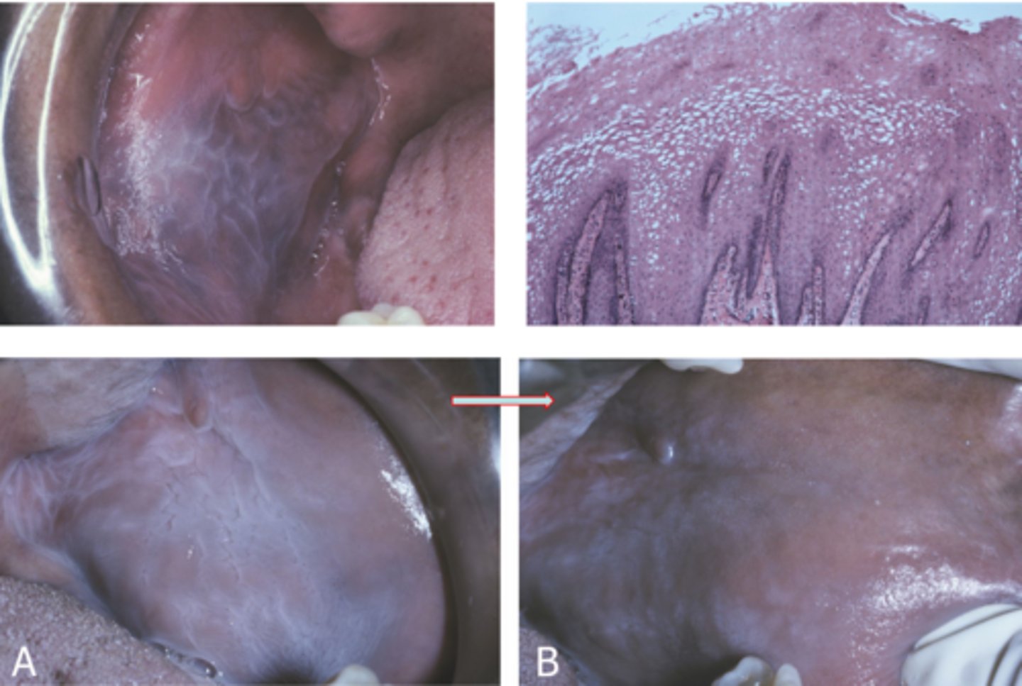 <p>features = increased glycogen</p><p>risk = dark skinned races and smokers</p><p>tx = none</p>