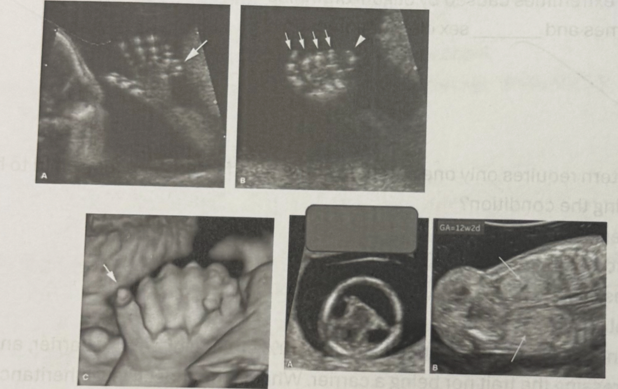 <p><span>What is the most likely diagnosis based on the sonographic findings in the image shown?</span></p><p><span>a. Trisomy 21 </span></p><p><span>b. Trisomy 18</span></p><p><span>c. Trisomy 13</span></p><p><span>d. Turner syndrome</span></p>
