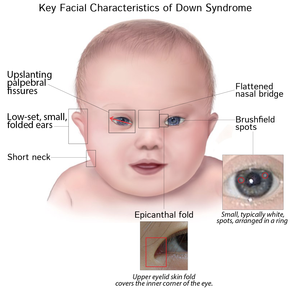<ul><li><p>low birth weight</p></li><li><p>hypotonia</p></li><li><p>low set ears</p></li><li><p>upslanting palpebral fissures &amp; epicanthic folds</p></li><li><p>brushfield spots </p></li><li><p>depressed nasal bridge</p></li><li><p>large protruding tongue</p></li><li><p>singular palmar creases </p></li></ul>