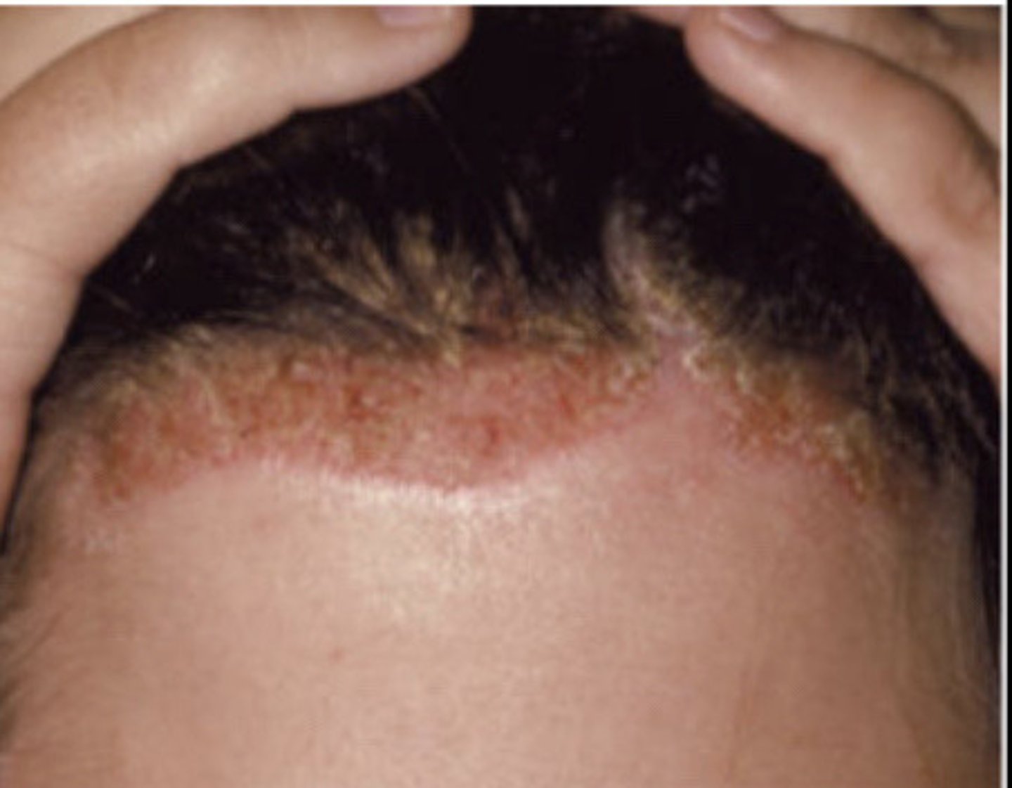<p>Sebborhic Dermatitis</p>