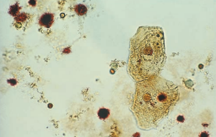 Squamous epithelial cell stained with phenazopyridine