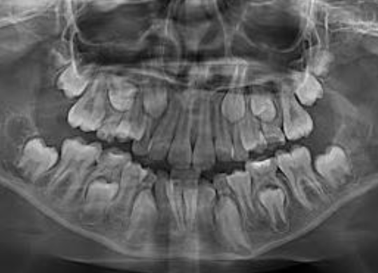 <p>Permanent teeth that replace primary teeth</p>