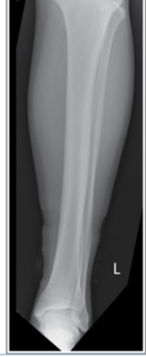 <p>Externally rotated</p>