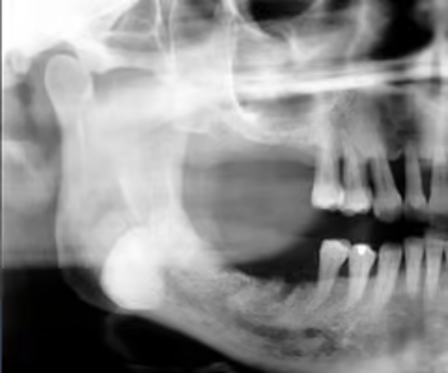 <p>What is the diagnosis?</p><p>Patient presents with a radiograph that shows a well defined, uniformly radiopaque exophytic mass (the same density as cortical bone), located on the posterior inferior mandible.</p>