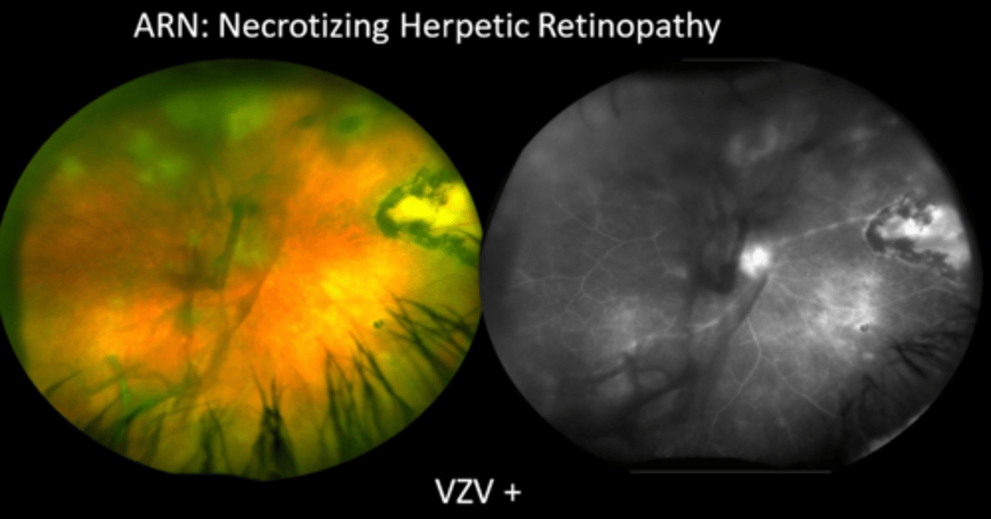 <p>What are 3 classes of intravitreal anti-infective injections?</p>