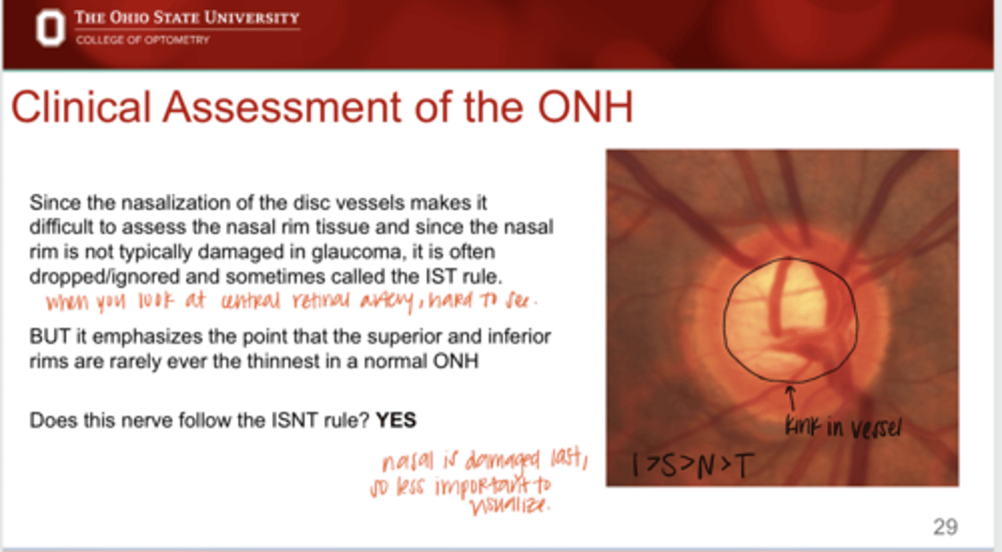 <p>______ of the disc vessels makes it difficult to assess the nasal rim tissue</p>