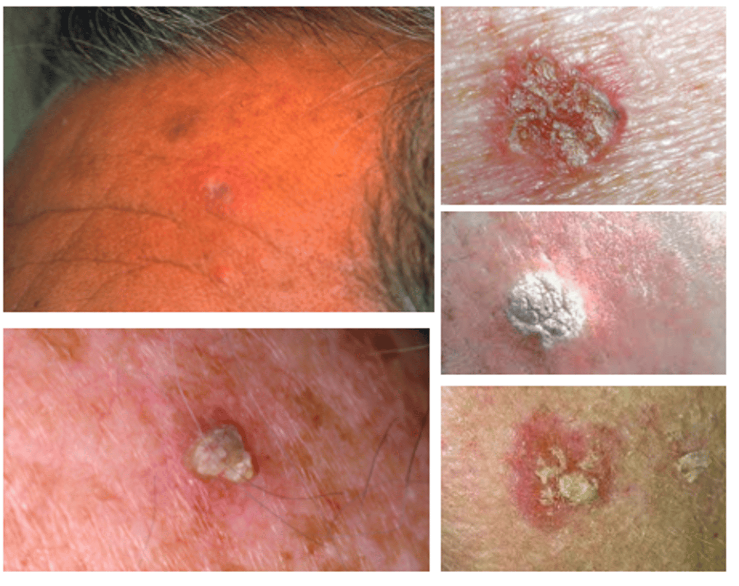 <p>diagnose this:</p><p>Single or multiple, discrete, dry, rough adherent scaly lesions</p>