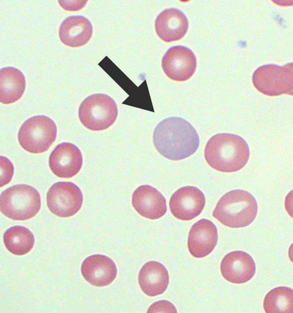 Name this RBC Abnormality.