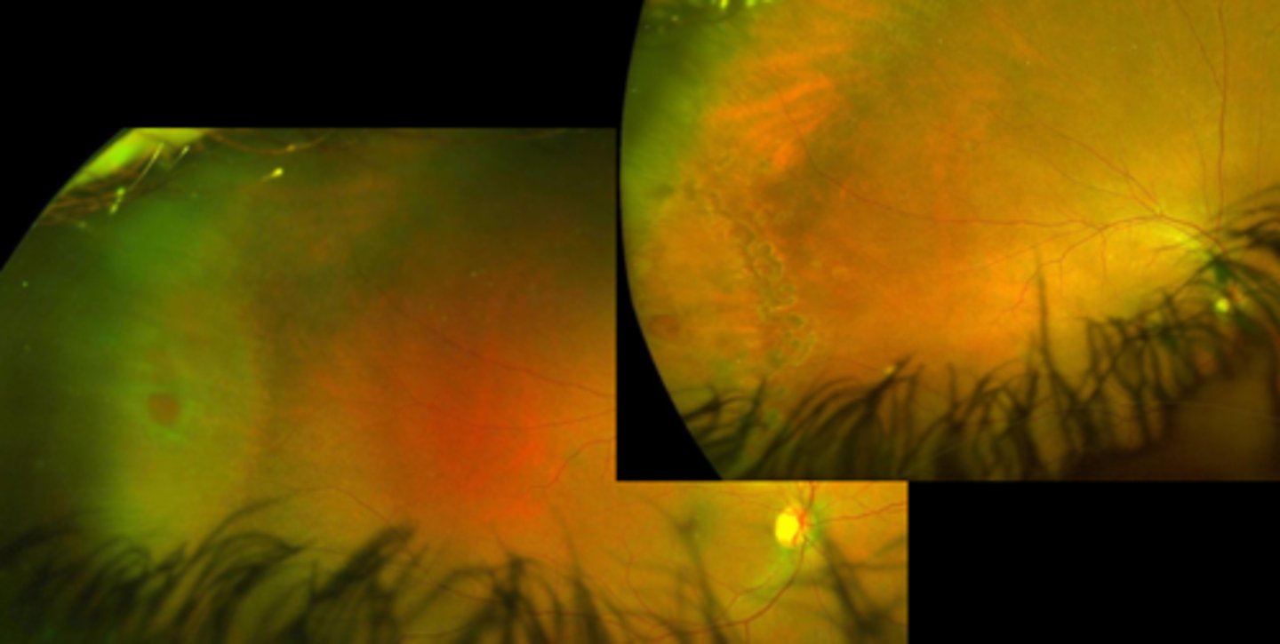 <p>What are some limitations to laser retinopexy?</p>