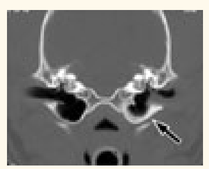 <p>Otoscopic examination is required for dogs or cats presented with peripheral vestibular disease</p><p>clinical history of previously diagnosed otitis externa </p><p>Medical treatment (ear flush and/or myringotomy) or surgical</p>