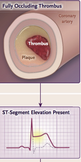 ST depression &/or T wave inversion in the affected leads, as well as possibly

ST elevation if the thrombus is associated with reperfusion.

ST segment elevation is present
