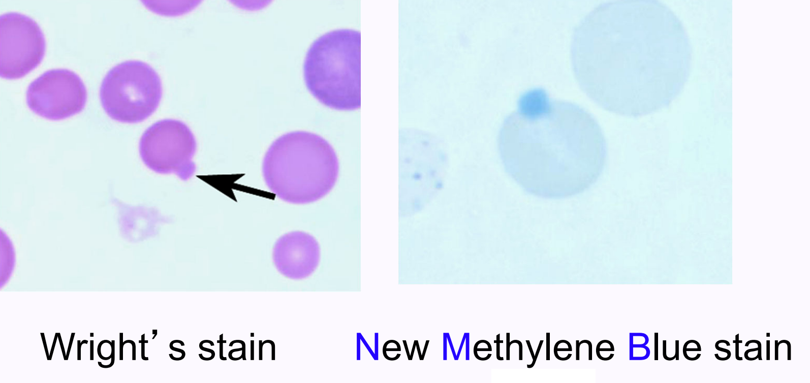 <ul><li><p>precipitated, denatured “blob” of globin resulting from oxidation of hemoglobin (oxidative damage)</p></li><li><p>difficult to see on Wright’s-stained smears; easier to visualize with New Methylene Blue stain</p></li></ul><p></p>