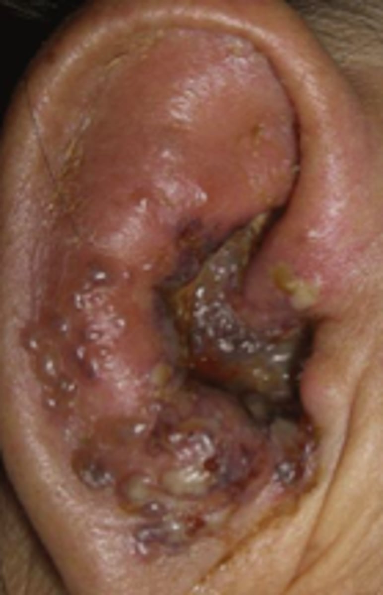 <p>Viral Skin Infections:</p><p>type of Herpes Zoster complication:</p><p>- <strong>involvement of facial and auditory nerves</strong></p><p><strong>- can cause lesions in the ear/tympanic membrane, facial paralysis, severe ear pain</strong></p><p><strong>- may lead to permanent deafness, vertigo, and facial muscle weakness</strong></p>